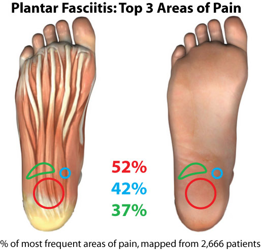 plantar fascia pain spots