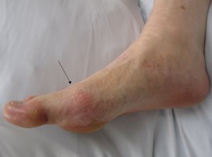 gout-foot