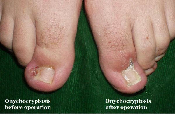ingrown-toenail-onychocryptosis-wedge-resection