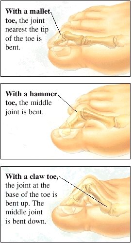 mallet-hammer-claw-toe