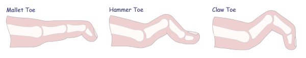toe-deformities