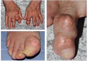 tophaceous-gout