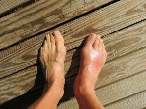 Is There a Home Treatment for Flat Feet?